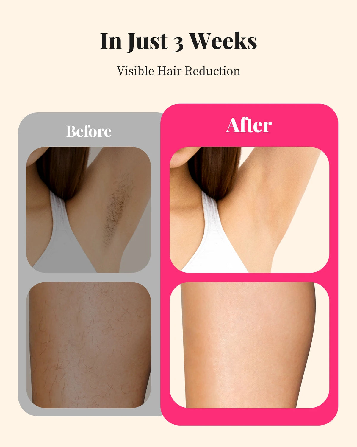 Totmizby Ipl Hair Removal Epilator With 990000 Flashes