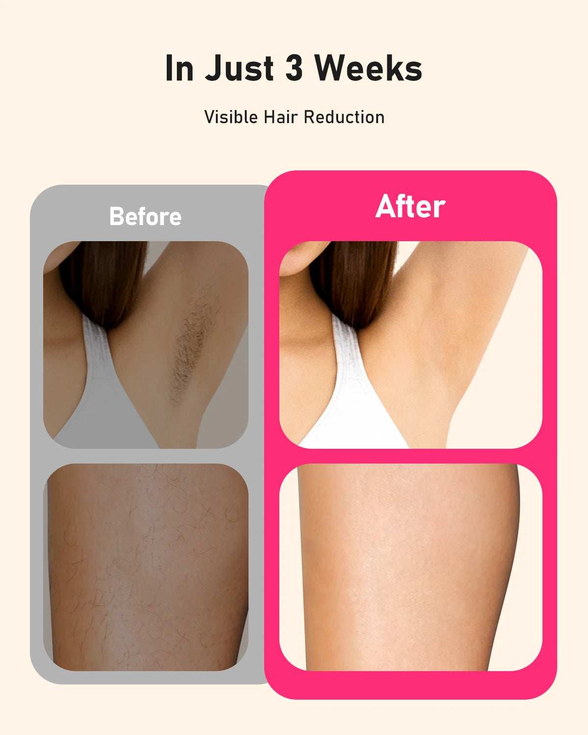 LYSMOSKI At Home IPL Hair Removal Device For Women Men